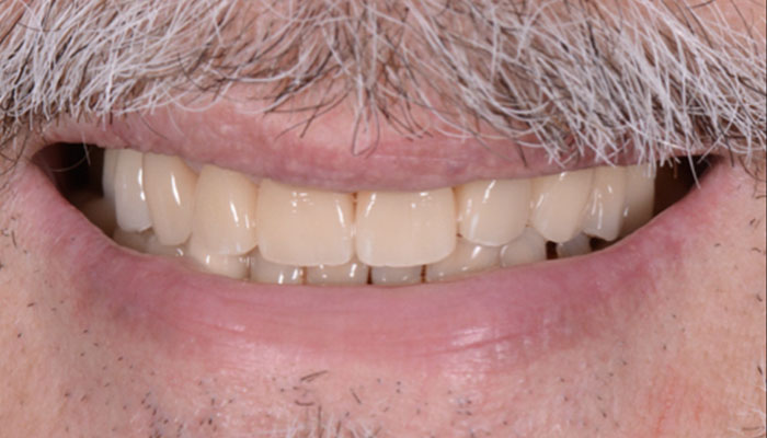 after dental implant