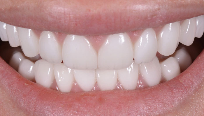 Dental Implants 5