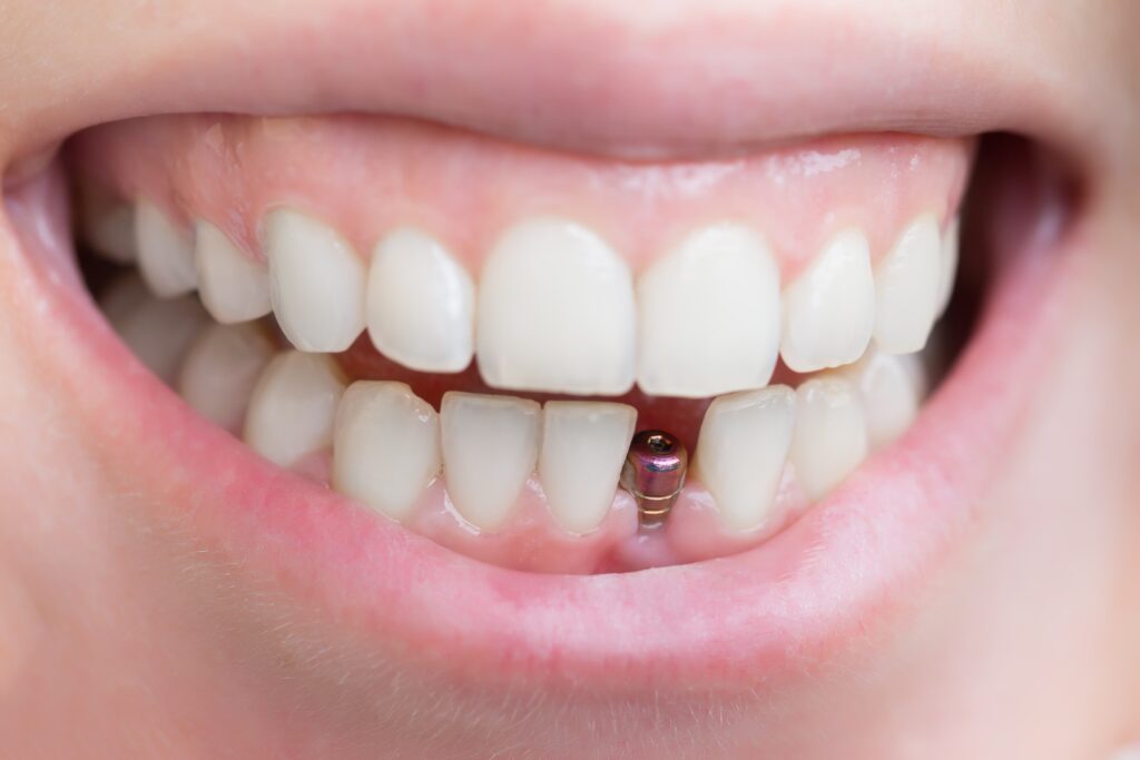 Single tooth dental implants - Marylebone Implant Centre