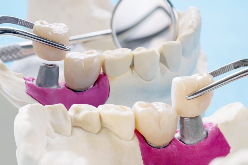 Zirconia dental implants - Marylebone Implant Centre